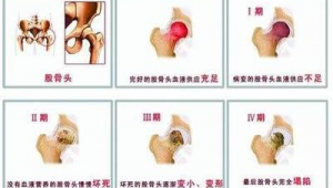 股骨头坏死患者群（股骨头坏死自我治愈群）